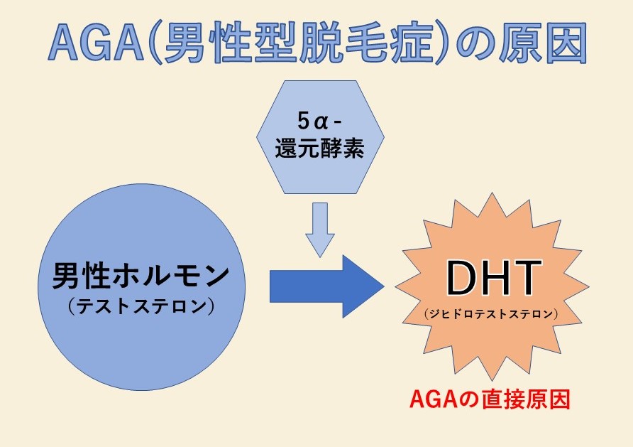 AGAの原因