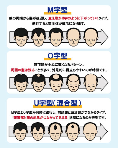 AGAの進行パターン