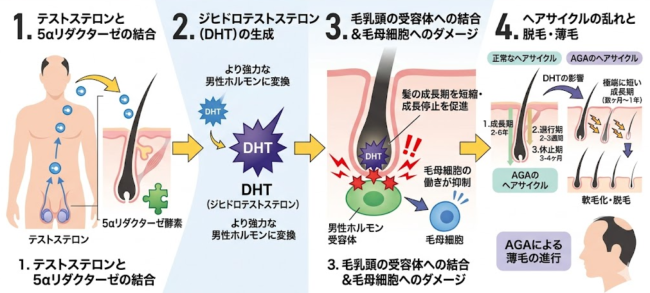 DHT（ジヒドロテストステロン）によるAGA進行のメカニズム【図解】