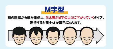 M字ハゲ