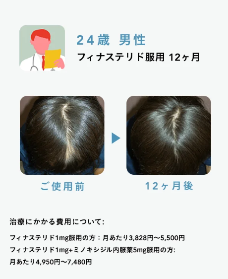 Oops HAIR(ウープスヘア)の症例写真3】24歳 男性 フィナステリド服用12か月