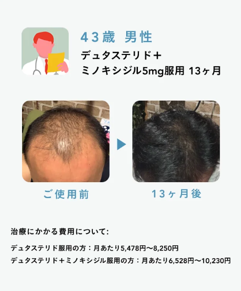 Oops HAIR(ウープスヘア)の症例写真4】43歳 男性 デュタステリド＋ミノキシジル5mg服用13ヵ月