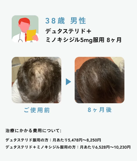 Oops HAIR(ウープスヘア)の症例写真5】38歳 男性 デュタステリド＋ミノキシジル5mg服用8ヵ月
