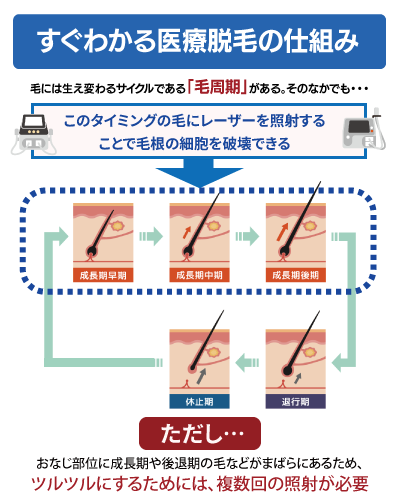 すぐわかる医療脱毛の仕組み