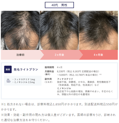 クリニックフォア症例発毛ライトプラン