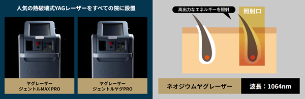 熱破壊式YAGレーザーをすべての院に設置