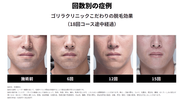 ゴリラクリニックの症例写真