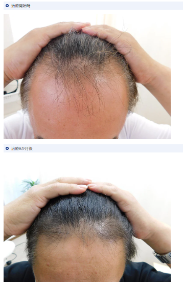 ノアAGAクリニック 宇都宮院の症例写真