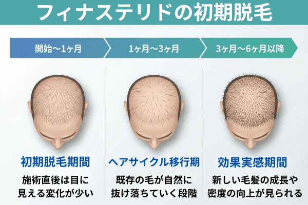 フィナステリドの初期脱毛