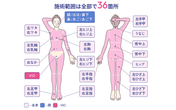 フレイアクリニック 全身脱毛+VIO+顔
