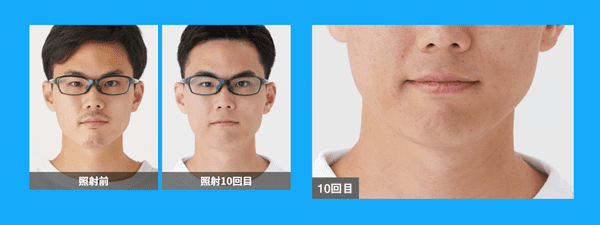 メンズリゼ 医療脱毛の症例写真