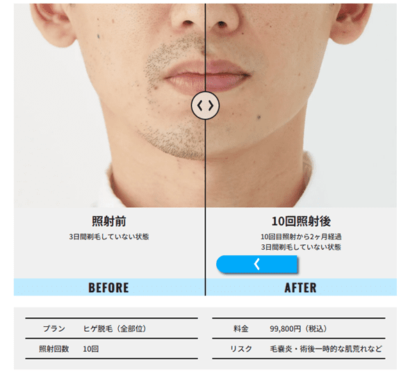 メンズリゼ 症例写真