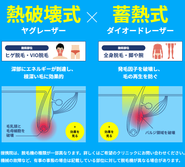 メンズリゼ 脱毛器図解