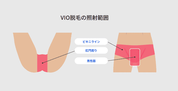 レジーナクリニックオム VIO脱毛の照射範囲