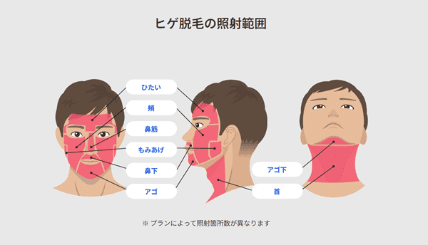 レジーナクリニックオム ヒゲ脱毛の照射範囲