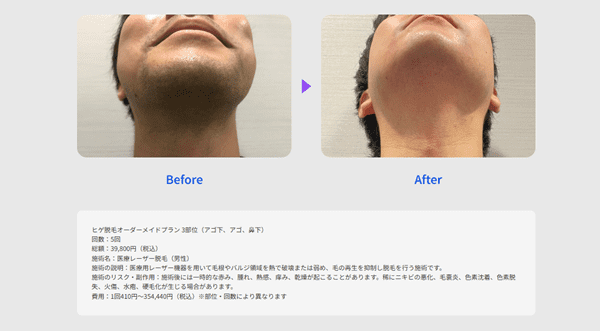 レジーナクリニックオム 医療脱毛の症例写真