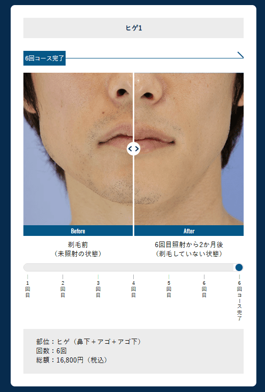 湘南美容外科 メンズ(男性)医療脱毛の症例写真