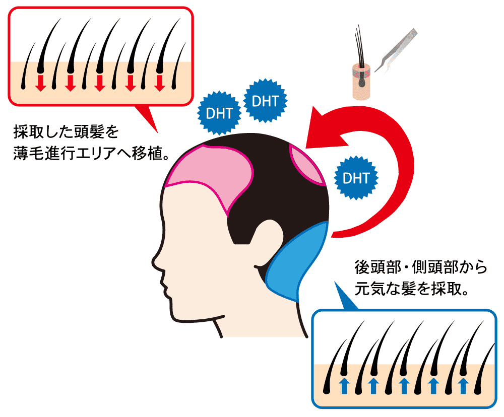 自毛植毛について