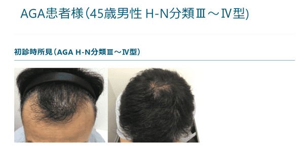 駅前AGAクリニック千葉津田沼院の症例写真